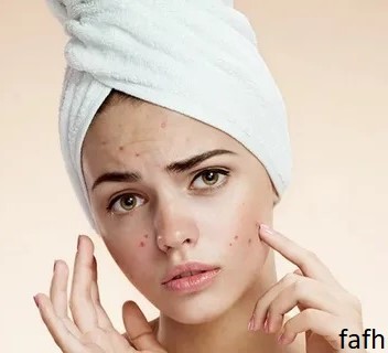 Acne causes, symptoms, remedies and treatment